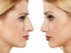 COMO-ENVEJECE-LA-NARIZ-Y-QUE-ES-LA-RINOPLASTIA-ANTIENVEJECIMIENTO-300×169