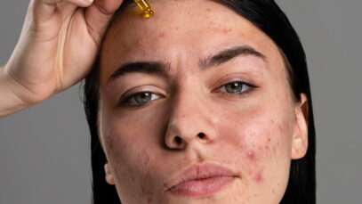 ¿QUÉ SON LOS INGREDIENTES COMEDOGÉNICOS?